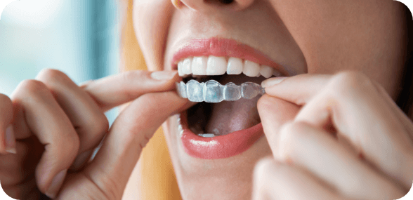 Woman wearing Digital Clear Alignerse
