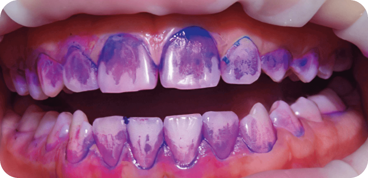 Guided Biofilm Therapy (GBT) Image